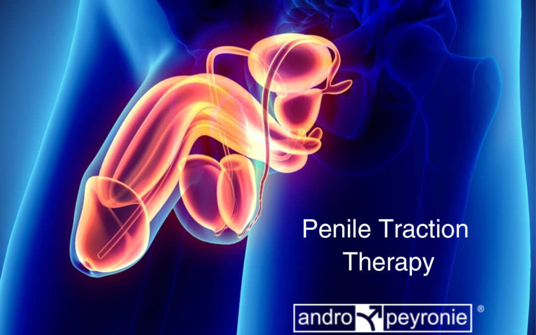 Penile Traction Therapy Device